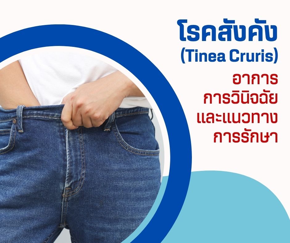 โรคสังคัง อาการ การวินิจฉัย และแนวทางการรักษา