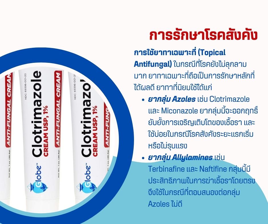 การรักษาโรคสังคัง