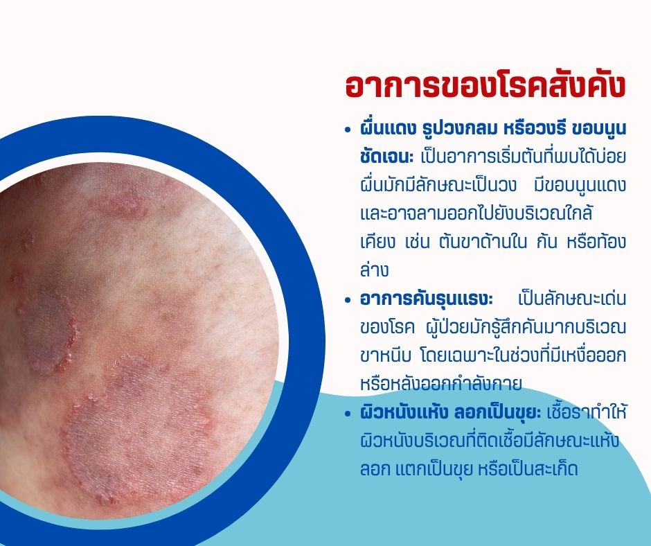 อาการของโรคสังคัง