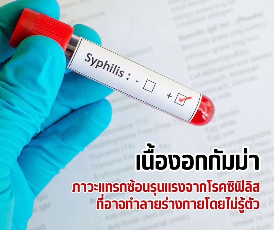 เนื้องอกกัมม่า ภาวะแทรกซ้อนรุนแรงจากโรคซิฟิลิส ที่อาจทำลายร่างกายโดยไม่รู้ตัว
