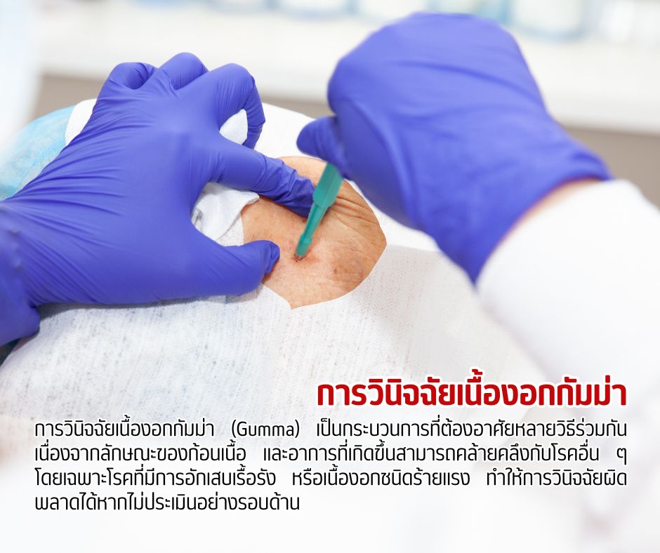 การวินิจฉัยเนื้องอกกัมม่า